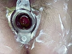 Hot Anal gaping amp tunnel plug Hairy 